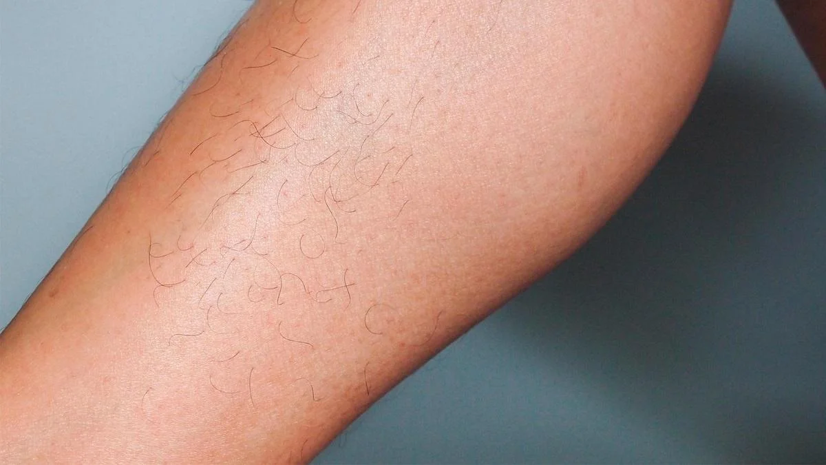 Before laser hair removal treatment